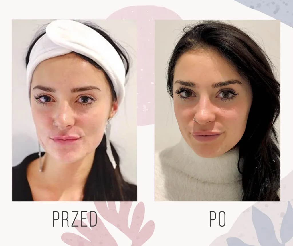 Ile kwasu hialuronowego w usta to bezpieczna dawka? Porady i przeciwwskazania