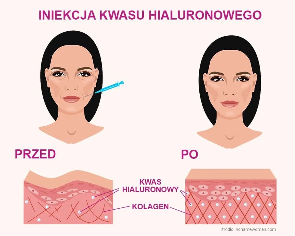 Jak spać po kwasie hialuronowym, by uniknąć problemów i osiągnąć najlepsze efekty