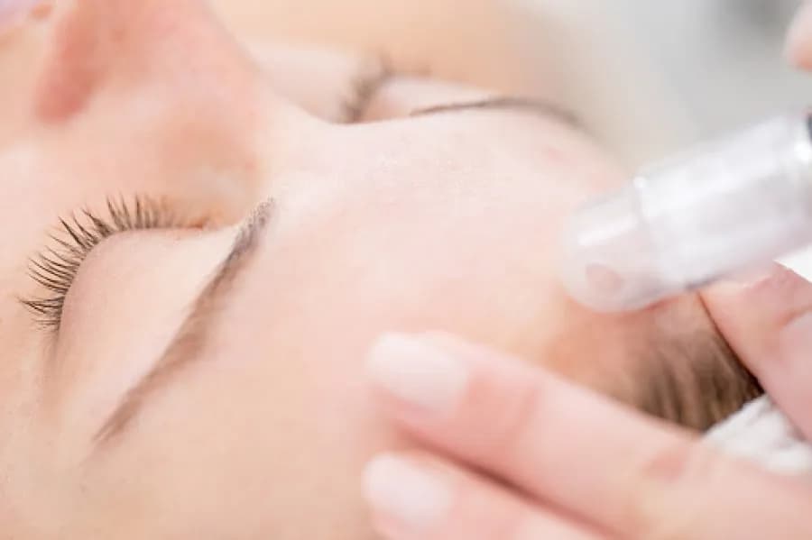 Peeling kawitacyjny czy mikrodermabrazja – która metoda lepiej odmłodzi twoją skórę?